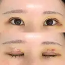 二重切開 東京エビスクリニック DAY 5 サムネイル用