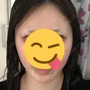 糸リフト A CLINIC（エークリニック） 大阪院 DAY 3 サムネイル用