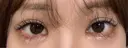 目尻切開 / タレ目形成・グラマラスライン（埋没） LOUIS CLINIC 二子玉川院【ルイクリニック】 DAY 4 サムネイル用