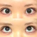 タレ目形成・グラマラスライン（切開） 形成外科と美容外科のクリニック池袋 DAY 46 サムネイル用