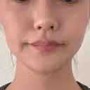 ボトックス（エラ・小顔） 新未来クリニック AFTER サムネイル用