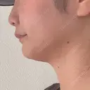 ボトックス（エラ・小顔） 新未来クリニック DAY 37 サムネイル用