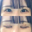 二重切開 東京エビスクリニック AFTER サムネイル用