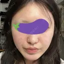 その他（口元） A CLINIC（エークリニック） 大阪院 DAY 4 サムネイル用