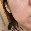 ピーリング（ニキビ・毛穴） / LDM・インテンスウルトラ ライズワン美容皮膚科クリニック AFTER サムネイル用