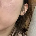 ピーリング（ニキビ・毛穴） / LDM・インテンスウルトラ ライズワン美容皮膚科クリニック DAY 4 サムネイル用