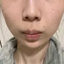 ボトックス（あご） / 肌ヒアルロン酸注入（たるみ・シワ改善） BIZENNクリニック【ビゼンクリニック】 AFTER サムネイル用