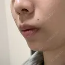 ボトックス（あご） / 肌ヒアルロン酸注入（たるみ・シワ改善） BIZENNクリニック【ビゼンクリニック】 DAY 26 サムネイル用