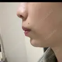 ボトックス（あご） / 肌ヒアルロン酸注入（たるみ・シワ改善） BIZENNクリニック【ビゼンクリニック】 DAY 26 サムネイル用