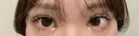 目尻切開 / タレ目形成・グラマラスライン（埋没） LOUIS CLINIC 二子玉川院【ルイクリニック】 DAY 5 サムネイル用
