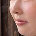 鼻尖形成（切開） / 鼻中隔延長（切開） / 軟骨移植 / 鼻孔縁下降 LIVIN CLINIC AFTER サムネイル用