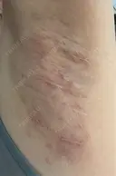 ワキ汗治療（切開） 石倉クリニック 水戸院 AFTER サムネイル用