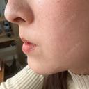 光治療（フォトフェイシャルなど） BITO BEAUTY CLINIC AFTER サムネイル用