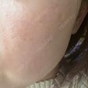 光治療（フォトフェイシャルなど） BITO BEAUTY CLINIC DAY 0 サムネイル用