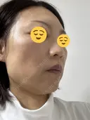 ボトックス（エラ・小顔） TCB東京中央美容外科 神戸院 DAY 9 サムネイル用