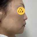 ボトックス（エラ・小顔） TCB東京中央美容外科 神戸院 DAY 9 サムネイル用