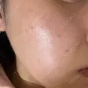 ピーリング（ニキビ・毛穴） / フラクショナルレーザー（毛穴・ニキビ跡） RIN BEAUTY CLINIC DAY 0 サムネイル用