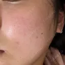 ピーリング（ニキビ・毛穴） / フラクショナルレーザー（毛穴・ニキビ跡） RIN BEAUTY CLINIC DAY 0 サムネイル用