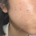 毛穴洗浄（ハイドラフェイシャルなど） / ルメッカ おおかみ美容のクリニック 新宿院 DAY 0 サムネイル用