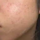 毛穴洗浄（ハイドラフェイシャルなど） / ルメッカ おおかみ美容のクリニック 新宿院 DAY 0 サムネイル用