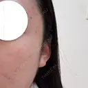 ミラノリピール ゆう美容クリニック AFTER サムネイル用