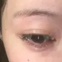 ヒアルロン酸注入（涙袋） Tokyo Tensei Clinic 大阪梅田院 DAY 0 サムネイル用
