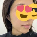 ピコレーザートーニング（美白・肝斑） / ピコスポット APスキンクリニック銀座 AFTER サムネイル用