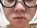 ほくろ・いぼ除去レーザー（肌） Fellez Clinic【フェルズクリニック】 DAY 0 サムネイル用