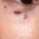 リジュラン 千葉美容外科アイビークリニック DAY 2 サムネイル用