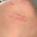 脂肪吸引（顔） / ネックリフト リラ・クラニオフェイシャル・クリニック DAY 86 サムネイル用