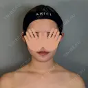 二重埋没 / 上まぶたの脂肪取り / 口角挙上 / ヒアルロン酸注入（涙袋） / ボトックス（エラ・小顔） / ヒアルロン酸注入（唇） / ボトックス（肩） アリエル美容クリニック 大宮院 DAY 111 サムネイル用