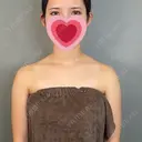 二重埋没 / 上まぶたの脂肪取り / 口角挙上 / ヒアルロン酸注入（涙袋） / ボトックス（エラ・小顔） / ヒアルロン酸注入（唇） / ボトックス（肩） アリエル美容クリニック 大宮院 DAY 111 サムネイル用