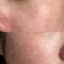 ピーリング（ニキビ・毛穴） / イオン導入 / ルメッカ ルラ美容クリニック 札幌本院 AFTER サムネイル用