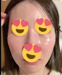 毛穴洗浄（ハイドラフェイシャルなど） / ピコレーザートーニング（美白・肝斑） 表参道ウィズ・クリニック DAY 3 サムネイル用