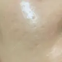 イオン導入 ルラ美容クリニック 岡山院 AFTER サムネイル用