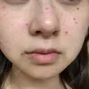 ほくろ・いぼ除去レーザー（肌） Fellez Clinic【フェルズクリニック】 DAY 1 サムネイル用