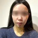 脂肪吸引（顔） / ジョールファット除去 / ボトックス（エラ・小顔） WOM CLINIC GINZA （ワム クリニック ギンザ） DAY 5 サムネイル用