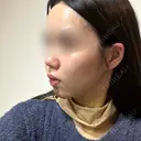 脂肪吸引（顔） / ジョールファット除去 / ボトックス（エラ・小顔） WOM CLINIC GINZA （ワム クリニック ギンザ） DAY 5 サムネイル用