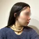 脂肪吸引（顔） / ジョールファット除去 / ボトックス（エラ・小顔） WOM CLINIC GINZA （ワム クリニック ギンザ） DAY 5 サムネイル用