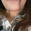 ボトックス（あご） / ボトックス（肩） 札幌TAクリニック AFTER サムネイル用