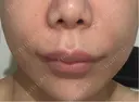 脂肪溶解注射（顔） ルラ美容クリニック 岡山院 AFTER サムネイル用