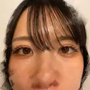 二重埋没 東京シンデレラ美容外科 池袋院 DAY 12 サムネイル用