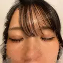 二重埋没 東京シンデレラ美容外科 池袋院 DAY 12 サムネイル用