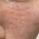 リジュラン ルヴィクリニック イオンドーム前院 DAY 1 サムネイル用