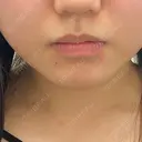 ボトックス（エラ・小顔） / ボトックス（口角） / ボトックス（ガミースマイル） YBC横浜美容外科 立川院 DAY 0 サムネイル用