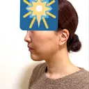 糸リフト / クマ治療 / 下まぶたたるみ取り / 脂肪注入（目の下） / ボトックス（あご） / その他（口元） アリエル美容クリニック 水戸院 DAY 21 サムネイル用