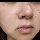 ほくろ・いぼ除去レーザー（肌） Fellez Clinic【フェルズクリニック】 DAY 2 サムネイル用