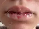 口唇縮小術 Stand by Beauty Clinic DAY 1 サムネイル用