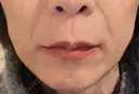 ハイフ（顔） 共立美容外科 大阪本院 DAY 9 サムネイル用
