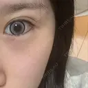 光治療（フォトフェイシャルなど） 眠れるスキンクリニック田町 AFTER サムネイル用